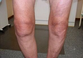 How to treat the knees together