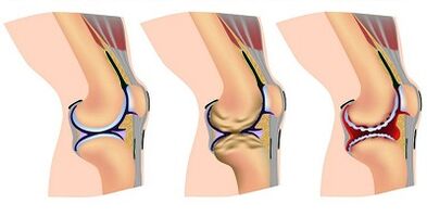 Stages of the knee joint joint joint