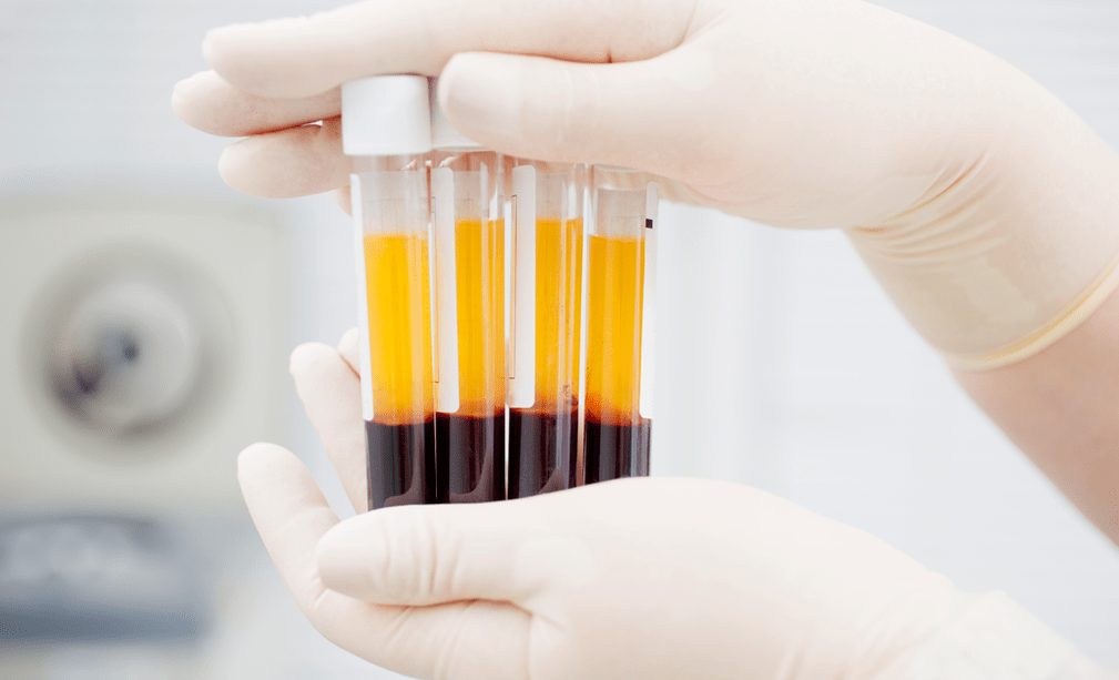 Platelet-rich plasma for PRP therapy for osteoarthritis